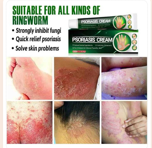 Psoriasis Cream - Herbal Plant Extracts